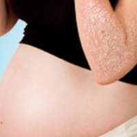 Псориаз и беременность. Советы врача
